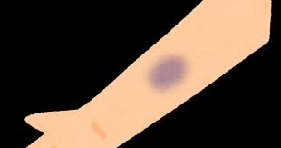 生まれつきある「あざ」が意味する４つのこととは？